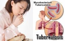 Ribuan Warga Kota Malang Mengidap Penyakit Tuberculosis 